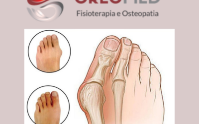 ALLUCE VALGO. FISIOTERAPIA O INTERVENTO?