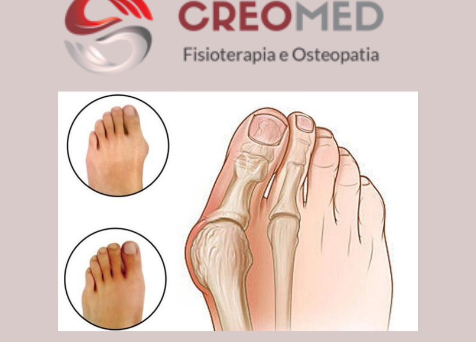 ALLUCE VALGO. FISIOTERAPIA O INTERVENTO?