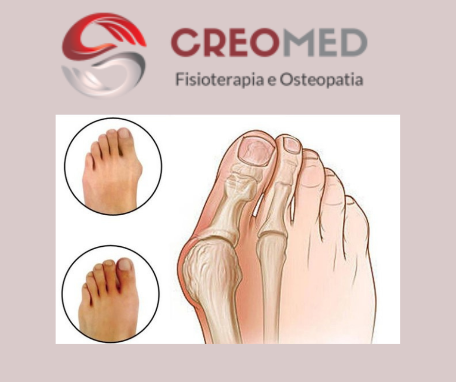 ALLUCE VALGO. FISIOTERAPIA O INTERVENTO?