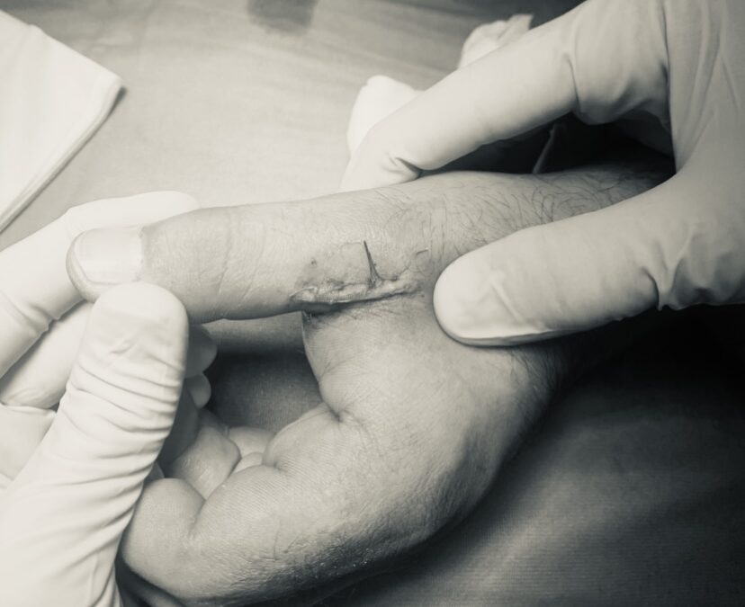 IL POLLICE DELLO SCIATORE. Lesione del legamento collaterale ulnare del primo dito della mano.