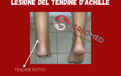 LESIONE DEL TENDINE D’ACHILLE