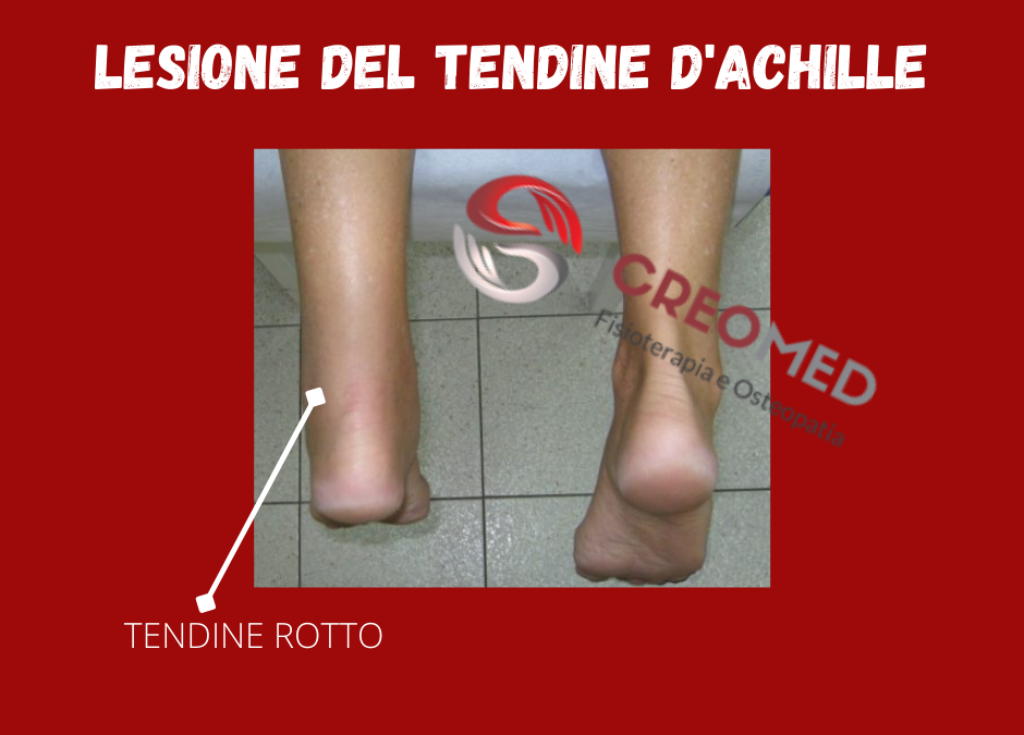LESIONE DEL TENDINE D’ACHILLE