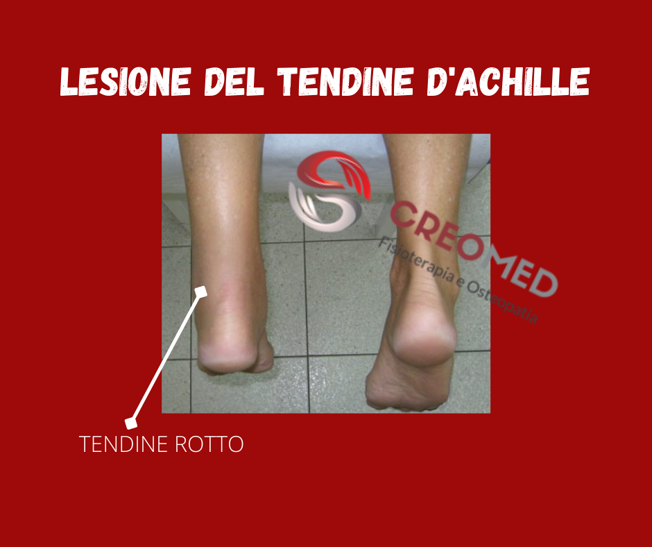 LESIONE DEL TENDINE D’ACHILLE